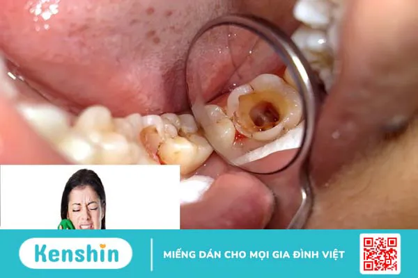 Tại sao răng lấy tủy rồi vẫn đau? 1