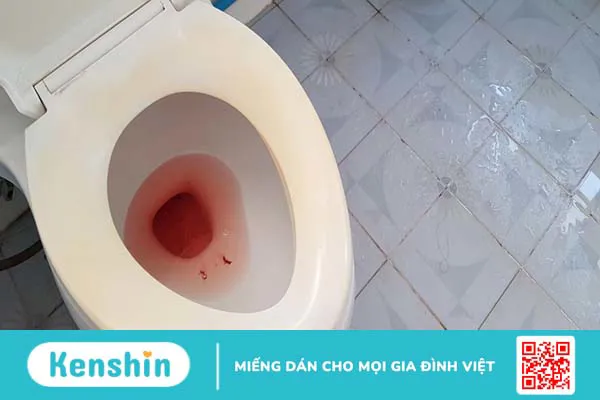 Tán sỏi niệu quản có ảnh hưởng gì không? 3