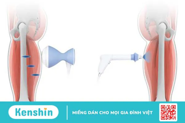 Tìm hiểu về sóng xung kích shockwave và ứng dụng trong y học 2