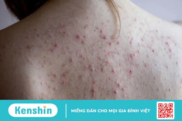 Tìm hiểu về tình trạng mụn nang ở lưng