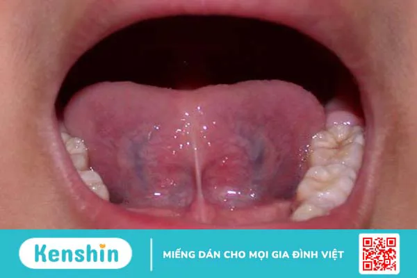 Tĩnh mạch dưới lưỡi màu đen có phải dấu hiệu cảnh báo vấn đề sức khoẻ nguy hiểm 1