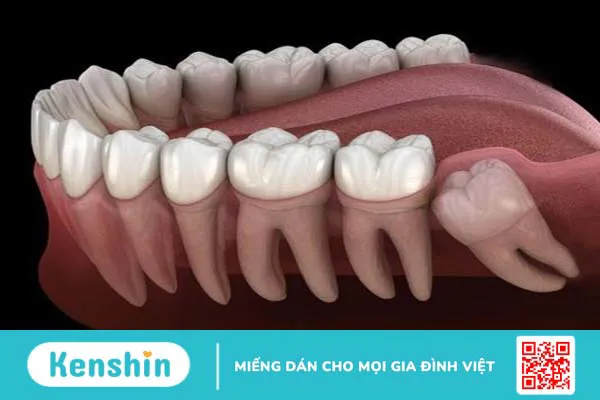 Tình trạng đau răng hàm dưới nói lên điều gì? Khắc phục bằng cách nào? 3