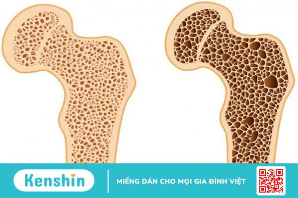 Truyền dịch canxi liệu có thực sự tốt cho người mắc bệnh loãng xương? 1