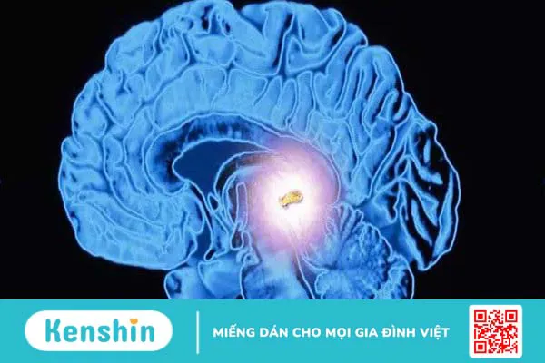 Tuyến tùng: Chức năng và các bệnh lý thường gặp 1