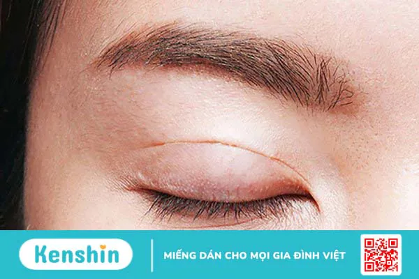 U bã đậu mí mắt có tái phát không? Điều trị u bã đậu ở mí mắt như thế nào? 4