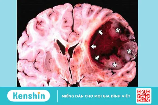 U bao thần kinh ngoại vi ác tính: Nguyên nhân, triệu chứng và điều trị 1