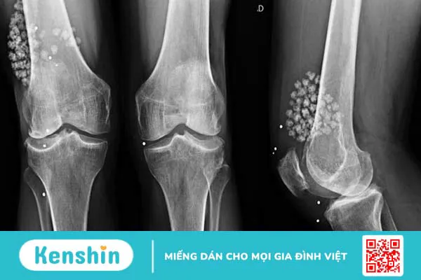 U sụn màng hoạt dịch: Chẩn đoán và chữa trị bệnh 1