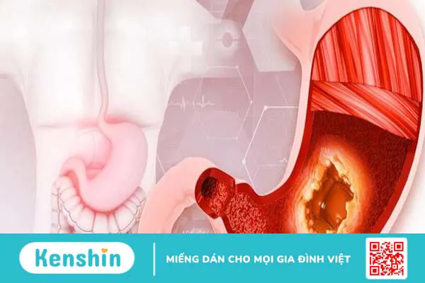 ung thư dạ dày thường di căn đến đâu điều trị thế nào 2