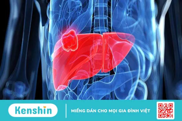 ung thư dạ dày thường di căn đến đâu điều trị thế nào 3