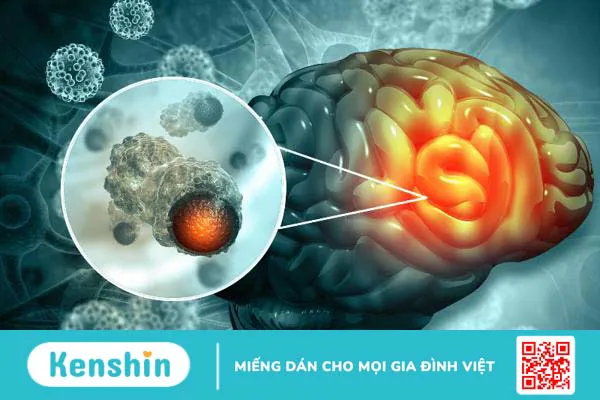 Ung thư di căn não: Những điều bạn cần biết 1