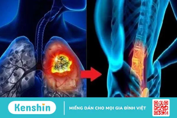 Ung thư di căn xương sống được bao lâu? Dấu hiệu, nguyên nhân và điều trị 1