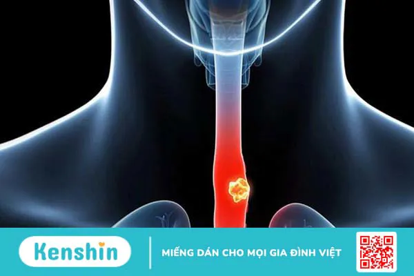 Ung thư thực quản di căn gan: Dấu hiệu và cách điều trị 1