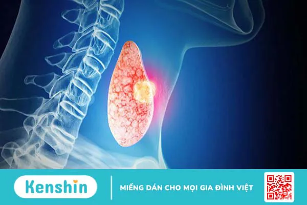 Ung thư tuyến giáp di căn hạch cổ: Dấu hiệu và cách điều trị 1