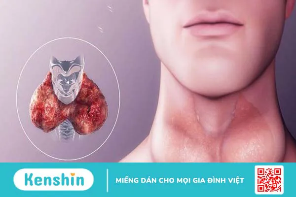 Ung thư tuyến giáp di căn hạch cổ: Dấu hiệu và cách điều trị 3