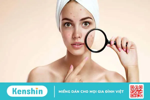 Uống biotin có nổi mụn không? Những tác dụng phụ của biotin mà bạn nên biết? 2