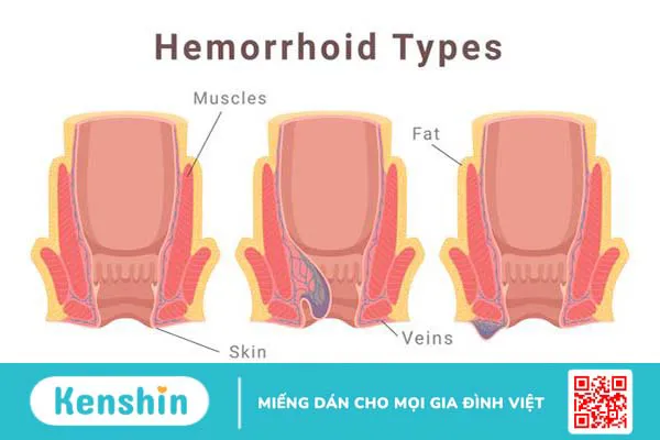 Phương pháp cắt trĩ milligan morgan là gì?2