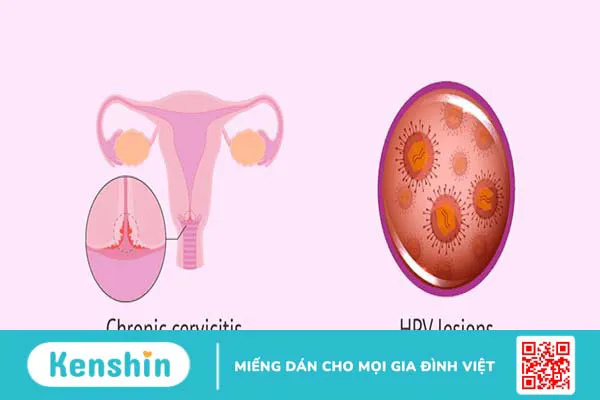 Vì sao phụ nữ lại dễ bị viêm cổ tử cung mãn tính? Cách phòng bệnh hiệu quả1