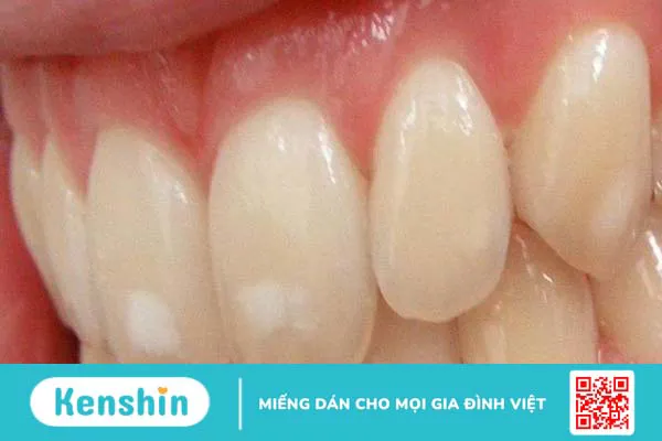 Vì sao răng có đốm trắng? Làm thế nào để khắc phục tình trạng này? 1