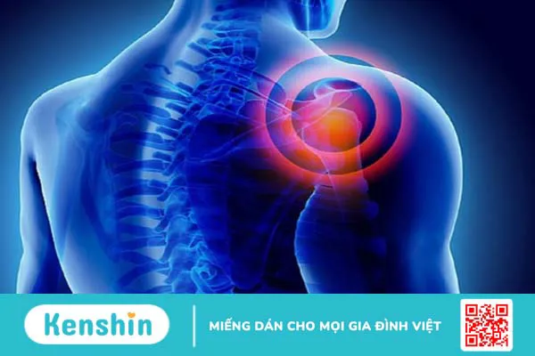 Viêm chu vai là gì? Nguyên nhân, triệu chứng và cách điều trị