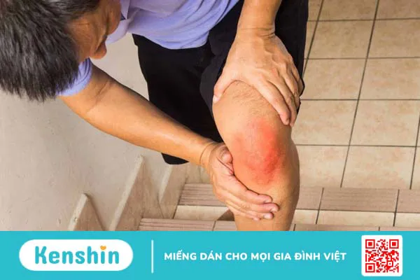 Viêm chu vai là gì? Nguyên nhân, triệu chứng và cách điều trị