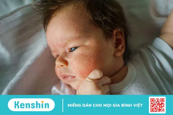 Viêm da cơ địa ở trẻ sơ sinh có đáng lo không và điều trị như thế nào? 1