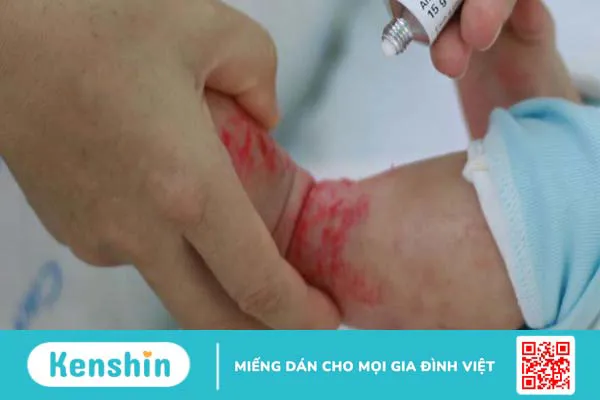 Viêm da cơ địa ở trẻ sơ sinh có đáng lo không và điều trị như thế nào? 3