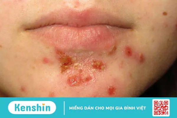 Viêm da liên cầu là gì? Nguyên nhân, triệu chứng và cách điều trị 2