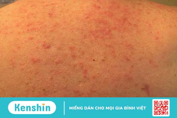 Viêm da mủ: Nguyên nhân gây bệnh và lưu ý khi điều trị 1