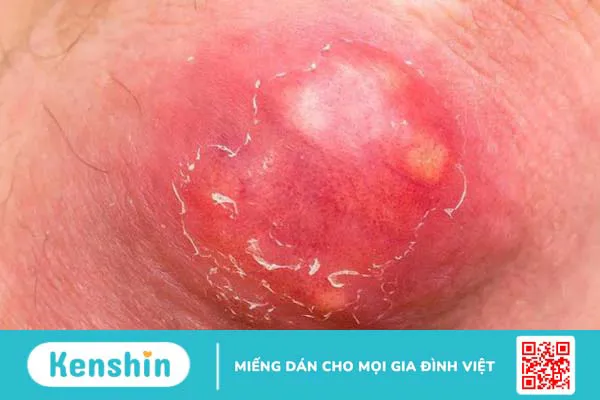 Viêm da mủ: Nguyên nhân gây bệnh và lưu ý khi điều trị 3