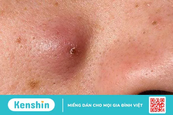 Viêm da mủ: Nguyên nhân gây bệnh và lưu ý khi điều trị 2