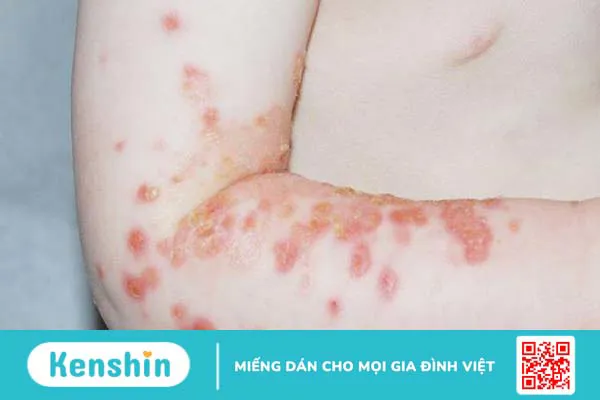 Viêm da mủ: Nguyên nhân gây bệnh và lưu ý khi điều trị 4