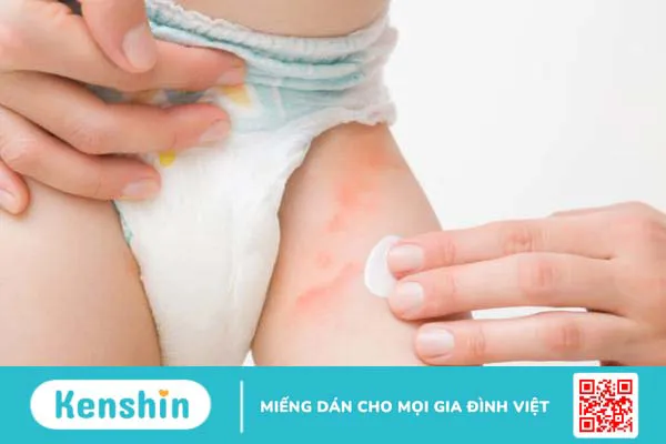 Viêm da mủ: Nguyên nhân gây bệnh và lưu ý khi điều trị 5