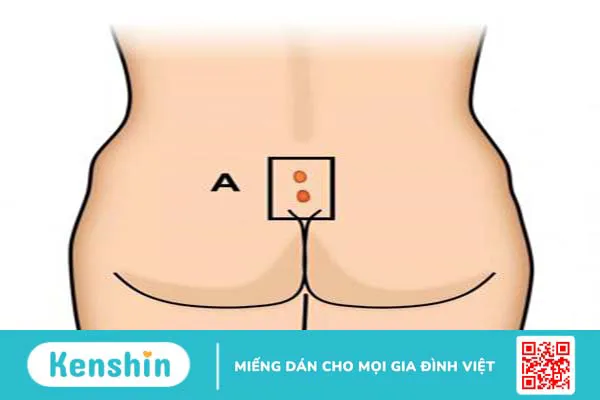 Viêm xoang lông vùng cùng cụt là gì?