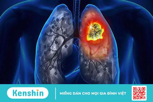 Xét nghiệm NSE là gì? Những điều cần biết 1