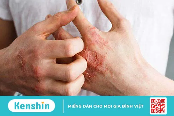 Xét nghiệm syphilis – Phương pháp sàng lọc bệnh giang mai hiệu quả 2