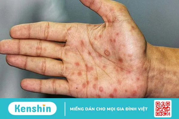 Xét nghiệm syphilis – Phương pháp sàng lọc bệnh giang mai hiệu quả 4