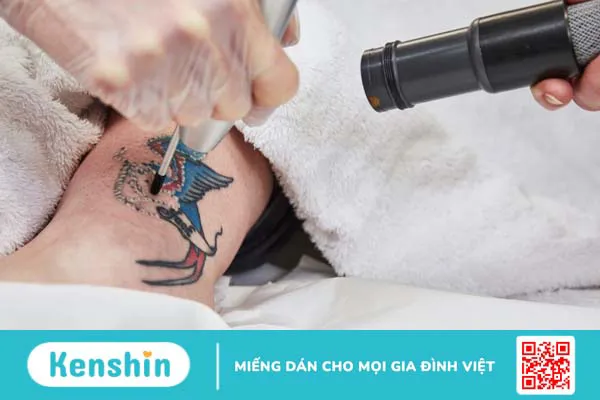 Xóa xăm bằng laser là gì? Có để lại sẹo không? 1