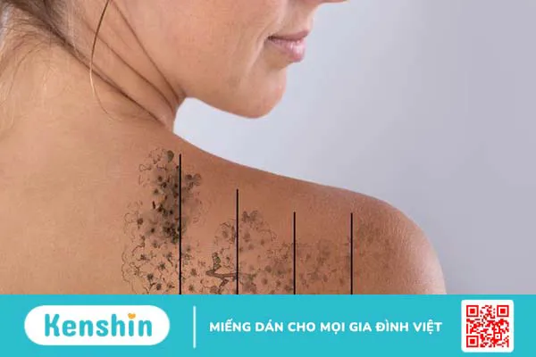 Xóa xăm bằng laser là gì? Có để lại sẹo không? 2